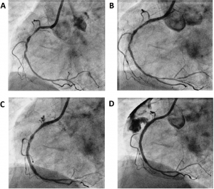 صورة D تظهر انفجار شرياني و تخريب الدم الى داخل غشاء القلب, الشبكة القلبية